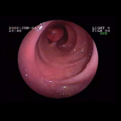 Colonoscopia