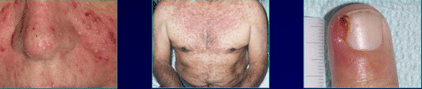 Dermatitis: efectos secundarios anticuerpos monoclonales