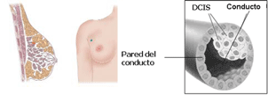 cáncer de mama. Estadío 0