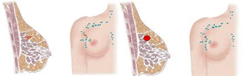 cáncer de mama. Estadío II