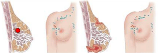 cáncer de mama. Estadío III