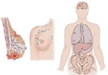 cáncer de mama. Estadío IV
