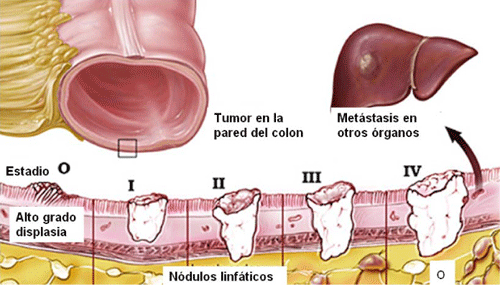 Estadíos cáncer colorrectal