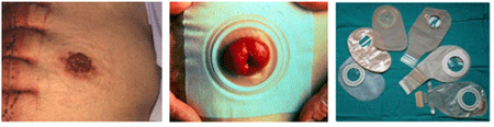 tres imágenes de estomas postcolostomía y colocación de bolsa colectora