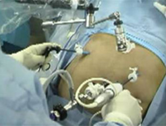 Laparoscopia