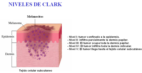 Niveles de Clark. Extensión cáncer de piel